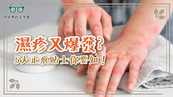 濕疹又爆發？5大止痕貼士你要知